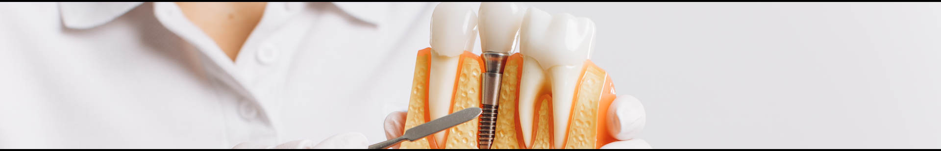 implants dentaires Libourne